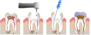 Edmonton Smiles Root Canal Treatment