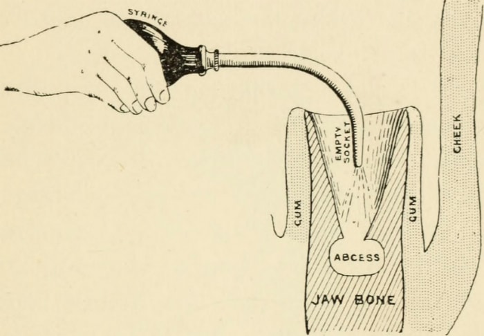 Gum Abscess