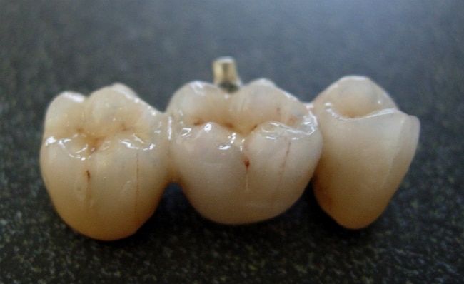 Metal-Free Restorations