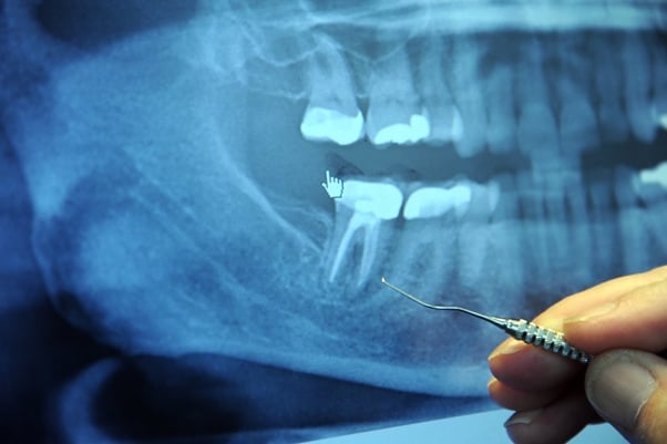 Care After Root Canal Treatment