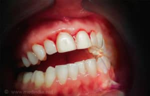 Treatment for Bleeding Gums