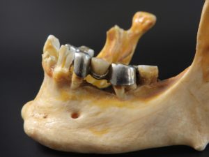 A dental Bridge