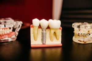 root canal treatment model