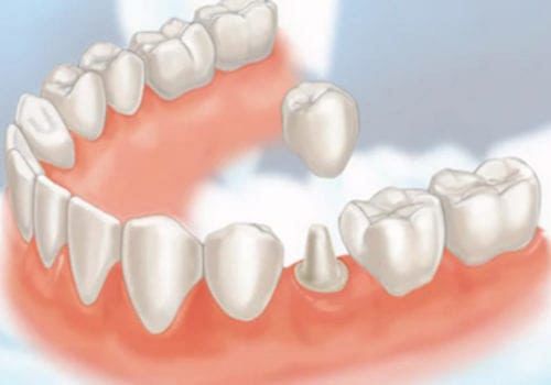 Dental Crowns Treatment | Restorative Dental Services Edmonton, Alberta