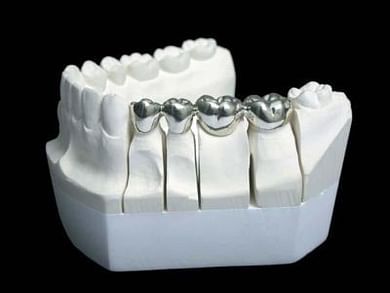 Metal-free Restorations | Restorative Dentistry Services | Edmonton Smiles