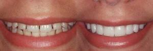 Cosmetic Dentist Before and After images