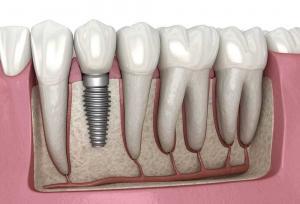 Graphic of Dental Implants