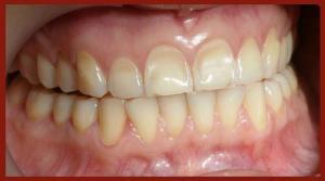 Teeth with Enamel Abrasion