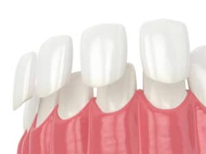 dental veneers