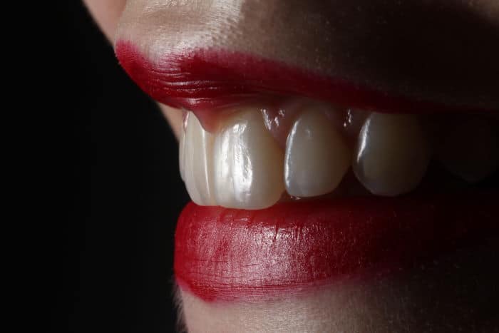 Cost of Teeth Whitening in Canada