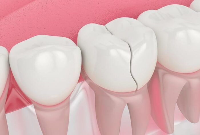 A broken tooth is one of the most common dental emergencies