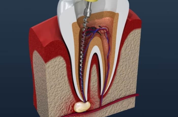 cost of root canal treatment in Edmonton