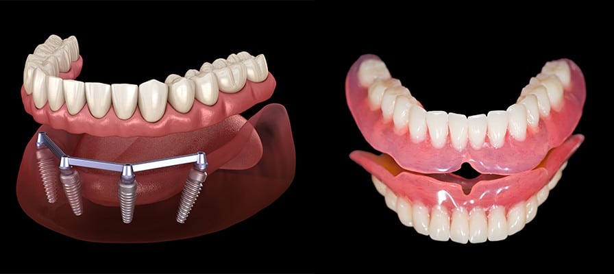 Dentures vs. Dental Implants