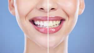 Cropped shot of a woman posing alone against a blue background after whitening her teeth